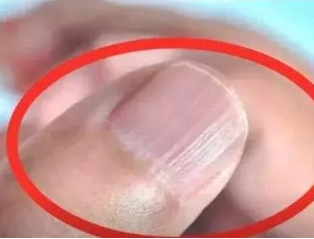 樱花草在线社区www韩国厂家分析手指甲有竖纹的根本原因 樱花草在线社区www韩国厂家分析手指甲有竖纹的根本原因